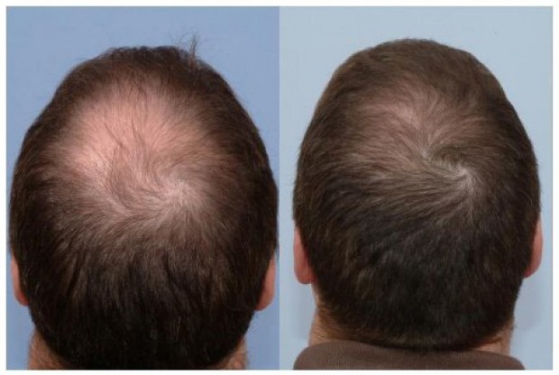 درمان ریزش مو با فیناستراید