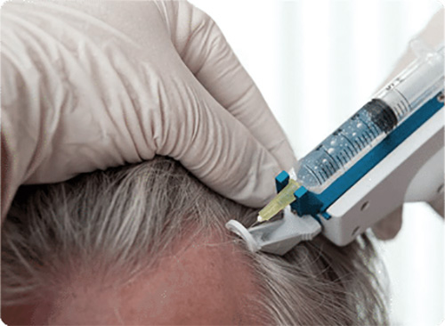 درمان ریزش شدید مو در مردان