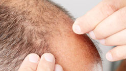 درمان جوش بعد از کاشت مو