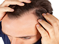  درمان قطعی ریزش مو در مردان 