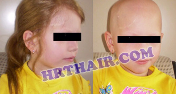 Gallery of Hair Restoration of Specific Diseases (HRT)