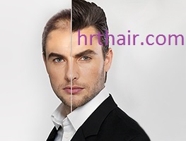 Hair Restoration of Specific Diseases