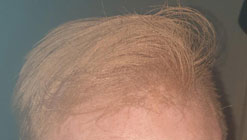 کاشت مو با الیاف چگونه است؟