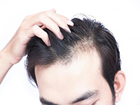   درمان ریزش مو در مردان به روش طب سنتی 