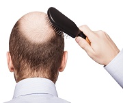 نحوه درمان ریزش موی مدل مردانه