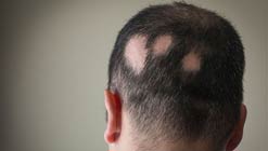 بیماری های شایع مو چیست و انواع آن کدام است؟