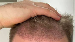 پوسته شدن سر بعد از کاشت مو