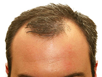  ریزش مو آندروژنیک، روش های تقویتی و درمان ریزش مو آندروژنیک
