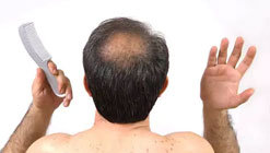 دلایل ریزش مو و درمان موقتی و قطعی آن