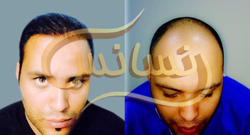 Gallery of SUT hair transplantation