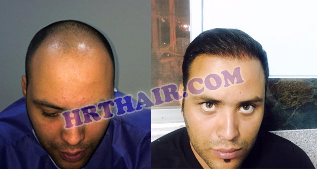 معرض الصور زراعة الشعر بطريقة SUT