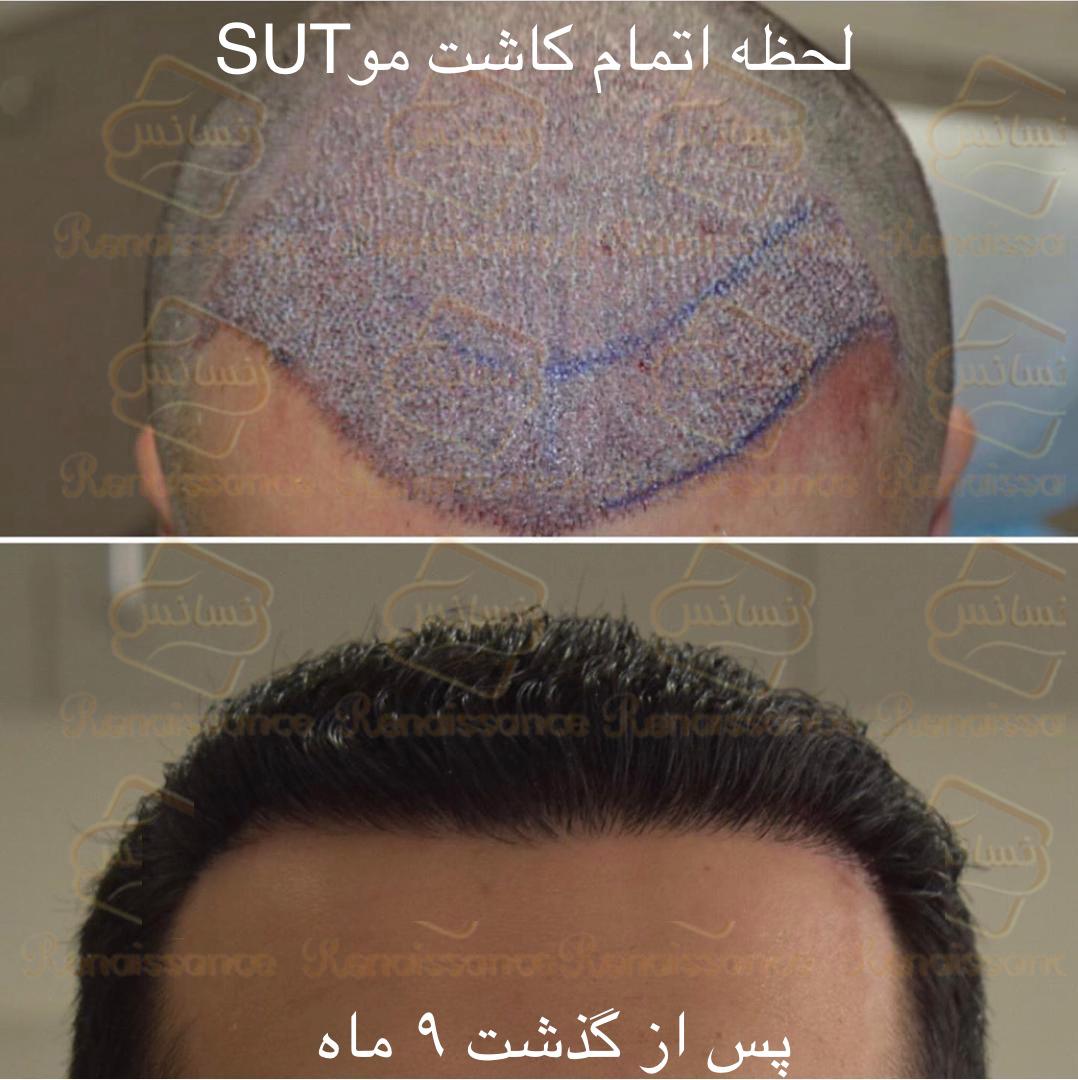 SUT hair transplantation
