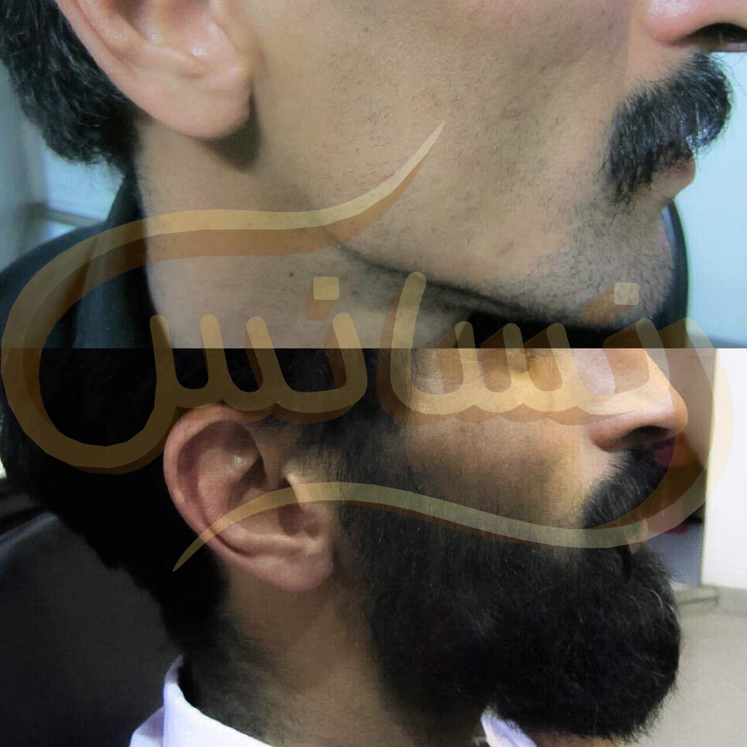 Beard and Mustache Transplant (SUT)