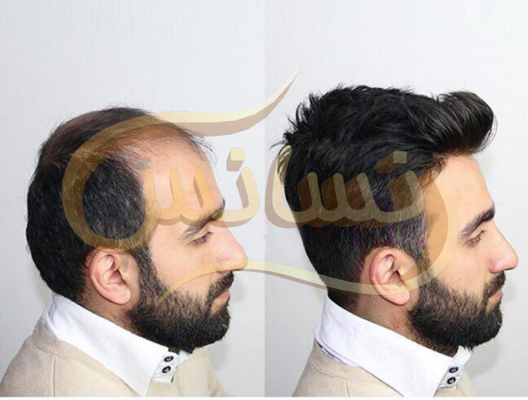 Hair restoration by HRT