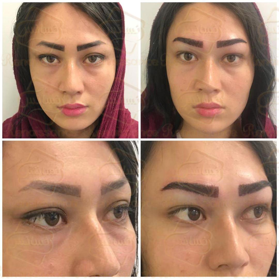 Natural eyebrow transplant (SUT)