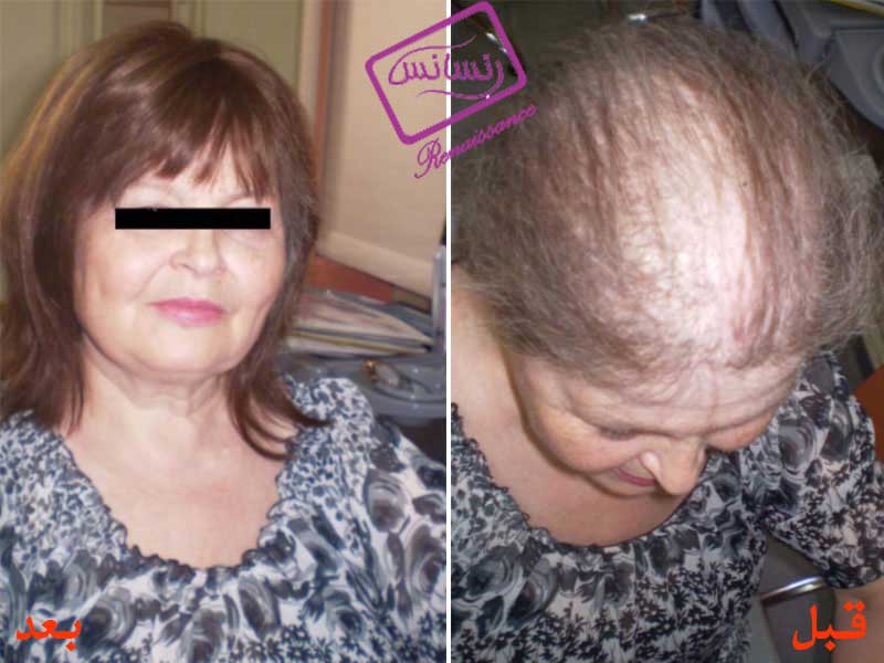 Hair Restoration of Specific Diseases (HRT)