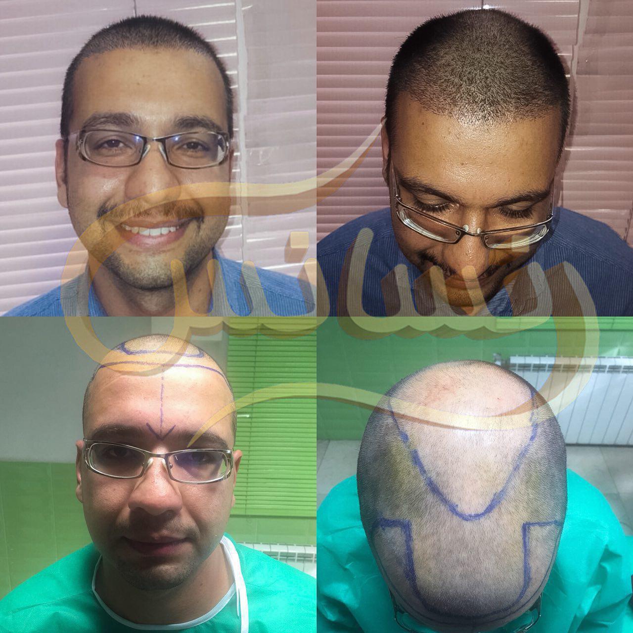 SUT hair transplantation