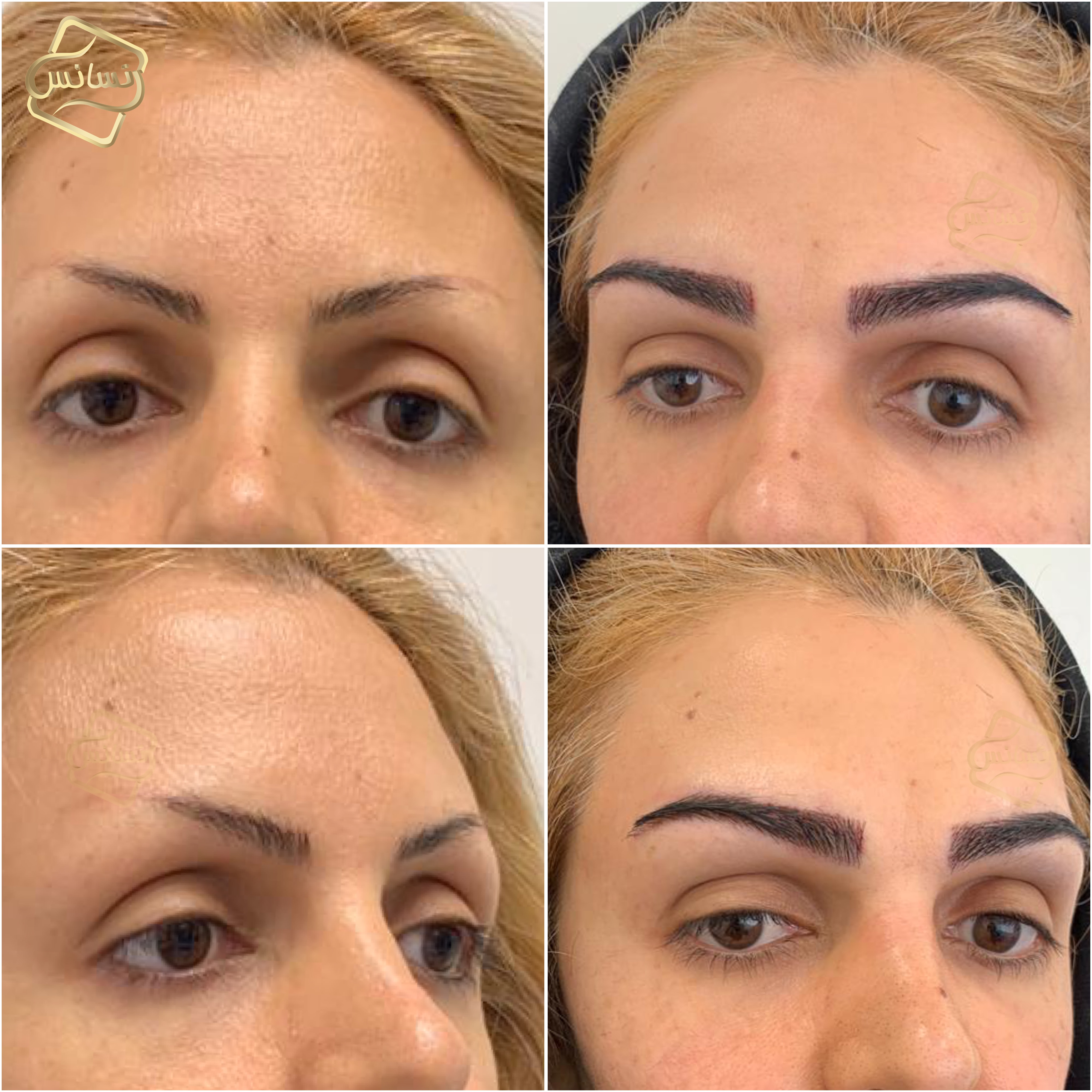 Natural eyebrow transplant (SUT)