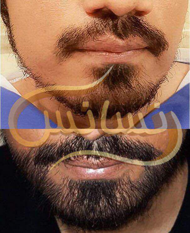 Beard and Mustache Transplant (SUT)