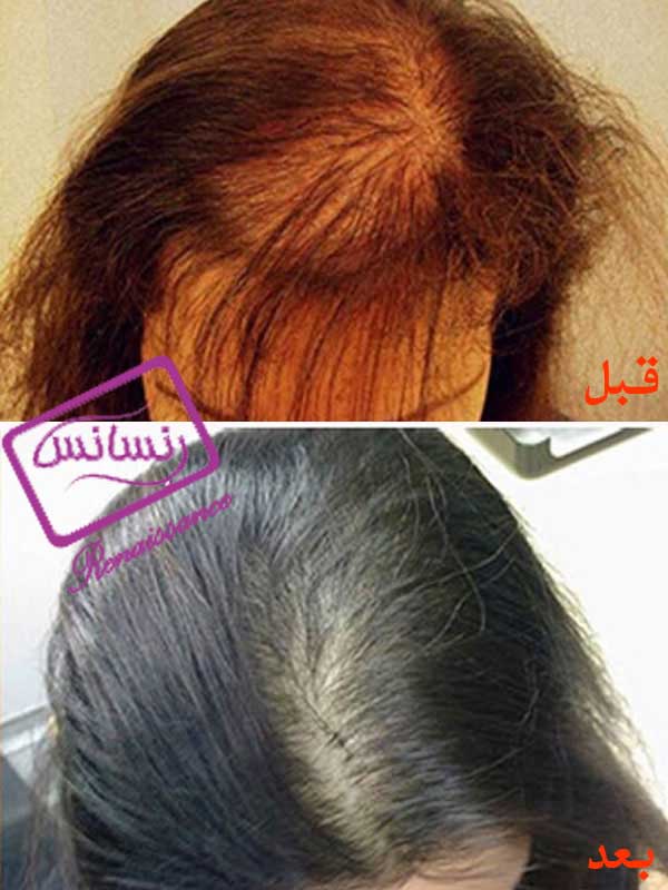 Hair Restoration of Specific Diseases (HRT)